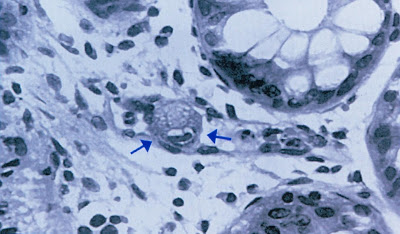 Figura 10- Material de biópsia do intestino grosso evidenciando a presença (seta) de uma partícula do vírus de Inclusão Citomegálica na lâmina própria.