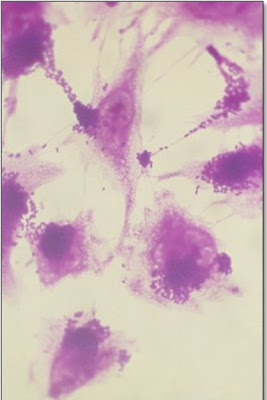 Figura 11- Incubação de Escherichia coli O111 em cultura de células HeLa evidenciando nichos da bactéria com aspecto característico de adesão localizada.