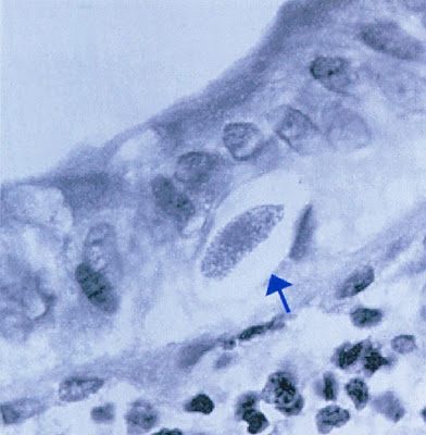 Figura 11- Material de biópsia do intestino delgado evidenciando (seta) a presença de um merozoita maduro de Isospora belli acima da membrana basal do enterócito.