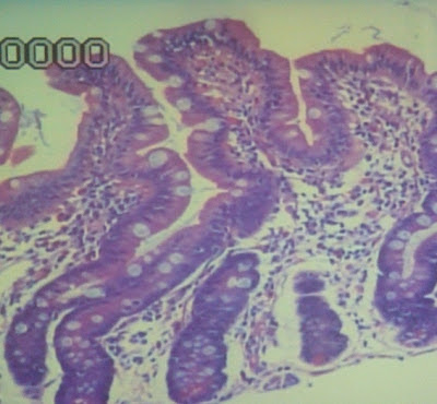 Figura 1. Espécime de biópsia do intestino delgado evidenciando atrofia vilositária subtotal com linfocitose intra-epitelial e discreto aumento do infiltrado linfoplasmocitário na lâmina própria (10X HE).