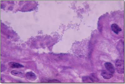 Figura 12- Material de biópsia de intestino delgado em microscopia óptica comum (grande aumento) de um paciente portador de diarréia persistente por infecção com Escherichia coli O111 demonstrando a presença de nichos de bactérias na superfície epitelial com intensa destruição dos enterócitos.