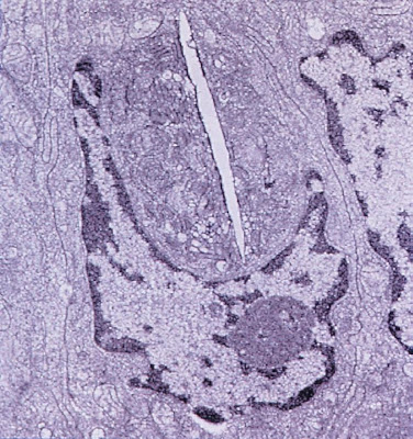 Figura 12- Ultramicrofotografia de células do intestino delgado evidenciando a presença de um merozoita de Enterocytozoon bieneusi comprimindo o núcleo de um enterócito.