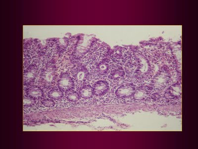 Figura 13. Material de biópsia retal  evidenciando colite e abscesso críptico.