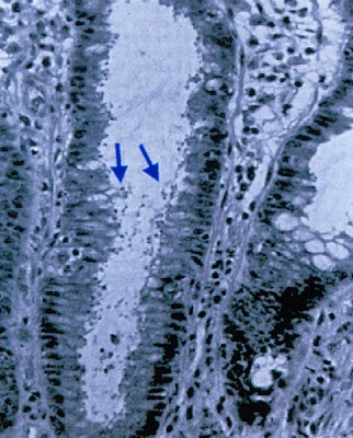 Figura 13- Infecção por Cryptosporidium (setas identificando os inúmeros microorganismos) infiltrado na luz da glândula críptica do intestino grosso.