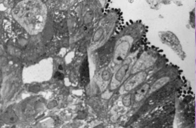 Figura 13- Material de biópsia de intestino delgado em microscopia óptica comum, corte semi-fino, de um paciente portador de diarréia persistente por infecção causada por Escherichia coli O111 evidenciando a presença de nichos de bactérias recobrindo a superfície epitelial do intestino delgado causando destruição das microvilosidades.