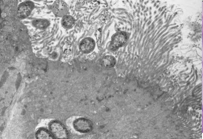 Figura 14- Ultramicrofotografia do enterócito em fase inicial de infecção por cepa de Escherichia coli O111; observar a destruição das microvilosidades e a presença de algumas bactérias no interior do enterócito.