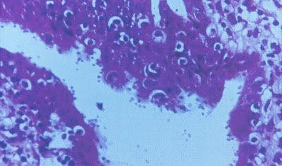 Figura 14- Infecção da vesícula biliar por Cryptosporidium. Notar a presença de inúmeros microorganismos na luz da vesícula biliar.