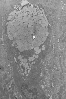 Figura 15. Material de biópsia do intestino delgado em microscopia eletrônica mostrando uma célula caliciforme produtora de muco.