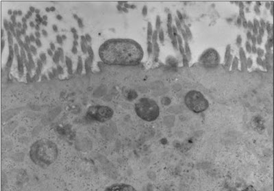 Figura 15- Ultramicrofotografia do enterócito com a clássica formação em pedestal devido a infecção por cepa de Escherichia coli O111; observar a bactéria firmemente aderida à superfície do enterócito e a completa destruição das microvilosidades.