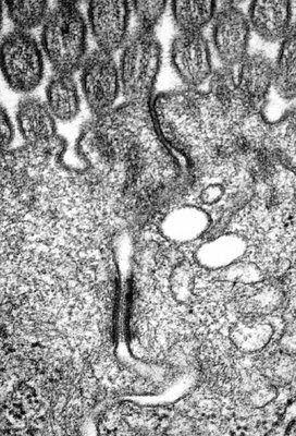 Figura 16. Material de biópsia de intestino delgado em microscopia eletrônica mostrando duas células adjacentes com poro intercelular intacto e a presença de um desmosoma em botão que confere a limitação do tamanho do poro.