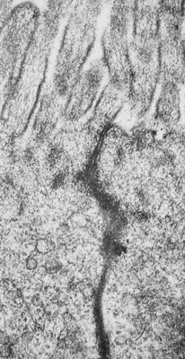 Figura 17. Material de biópsia de intestino delgado em microscopia eletrônica mostrando ruptura discreta do poro intercelular. Notar a presença, em negro, de um marcador macromolecular (Horseradish peroxidase) ao longo do espaço intercelular.
