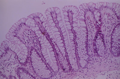 Figura 17- Mucosa colônica normal evidenciando epitélio preservado, infiltrado linfo-plasmocitário na lâmina própria e glândulas crípticas com a células repletas de muco.