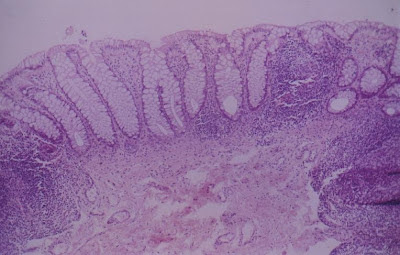 Figura 18- Mucosa retal sem alterações morfológicas evidenciando em ambas as laterais e no centro nódulos linfóides.