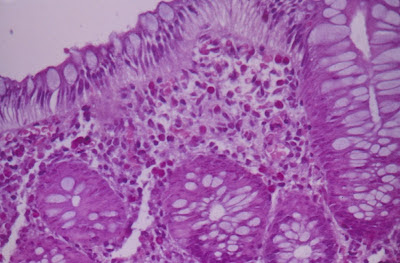 Figura 19- Colite eosinofílica: notar presença de eosinófilos no epitélio e em grande quantidade na lâmina própria.