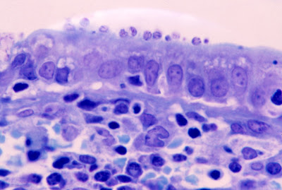 Figura 1- Material de biópsia de intestino delgado evidenciando atrofia vilositária sub-total e a presença de microorganismos de Cryptosporidium firmemente aderidos à superfície epitelial dos enterócitos.