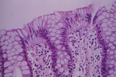 Figura 20- Colite eosinofílica: notar presença de eosinófilos em grande quantidade no epitélio e na porção superior da lâmina própria próxima ao epitélio.
