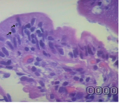 Figura 2. Espécime de biópsia do intestino delgado em maior aumento evidenciando uma vilosidade intestinal com a presença de linfócitos intra-epiteliais em grande quantidade, identificados pelas setas (100X HE).