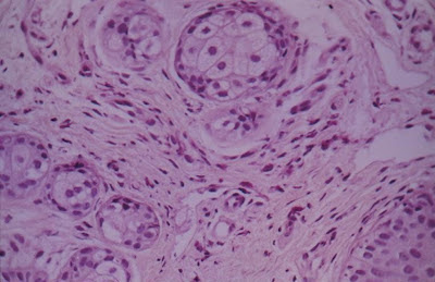 Figura 22- Colite eosinofílica: notar a presença de eosinófilos na muscular da mucosa.