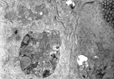 Figura 23. Material de biópsia do intestino delgado em microscopia eletrônica mostrando a formação de um corpo multivesicular, produto da ação degradativa lisosomal.