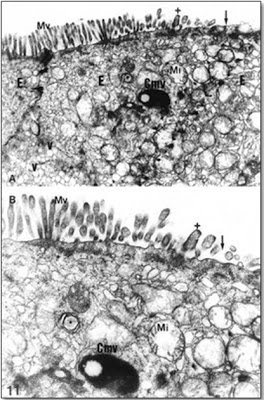 Figura 23- Ultramicrofotografia do intestino delgado de paciente portador de Enteropatia Ambiental evidenciando importante lesão das microvilosidades, as quais se encontram diminuídas em número e altura.