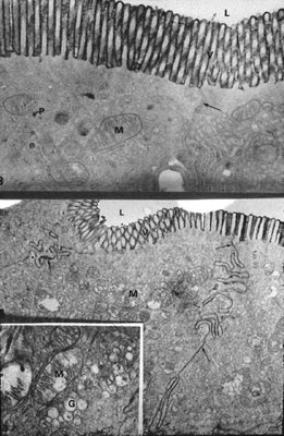 Figura 25. Material de biópsia do intestino delgado em microscopia eletrônica mostrando na figura superior duas células intestinais adjacentes submetidas à perfusão com o marcador macromolecular Horseradish peroxidase representado pela imagem enegrecida confinada à região das microvilosidades (V), L mostra o lumen intestinal. Observar o espaço intercelular (seta) totalmente preservado e a mitocôndria (M) intacta. Na figura inferior resultante da perfusão com sais biliares secundários observa-se que o marcador macromolecular provoca uma ruptura no poro intercelular e a imagem enegrecida estende-se ao longo de todo o espaço intercelular (seta). No detalhe podem ser observadas alterações importantes nas organelas com inchaço e degeneração da mitocôndria (M) e do aparelho de Golgi (G).