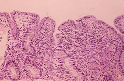 Figura 26. Material de biópsia do intestino delgado de paciente portador de Gastroenteropatia Eosinofílica, evidenciando importante atrofia vilositária e intenso infiltrado linfo-plasmocitário e eosinofílico na lâmina própria.