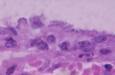 Figura 36. Material de biópsia de intestino delgado à microscopia óptica comum, grande aumento, mostrando nichos de Escherichia coli enteropatogênica firmemente aderidas à superfície mucosa do intestino delgado provocando intensa atrofia vilositária.