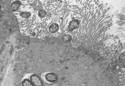 Figura 38. Material de biópsia do intestino delgado à microscopia eletrônica mostrando o início da lesão provocada por cêpa de Escherichia coli sobre as microvilosidades, levando a distorsão e alongamento das mesmas.
