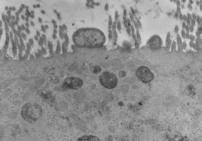 Figura 39. Material de biópsia do intestino delgado à microscopia eletrônica evidenciando a típica lesão em pedestal provocada por cêpa de Escherichia coli enteropatogênica. Notar que há total destruição das microvilosidades.