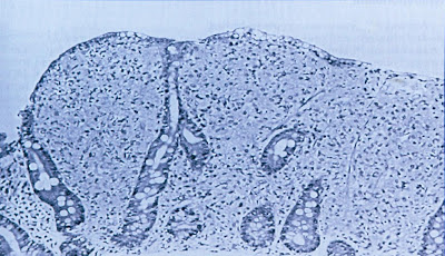 Figura 3- Material de biópsia de intestino delgado infectado pelo Mycobacterium avium intracellulare. 