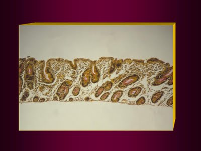 Figura 4. Material de biópsia de intestino  delgado evidenciando atrofia vilositária sub-total.