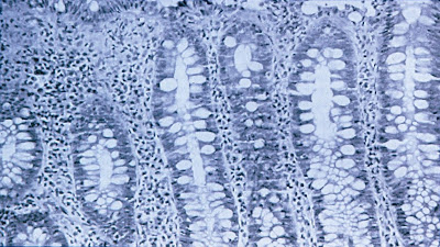 Figura 4- Material de biópsia do intestino grosso obtida na fase aguda da infecção pelo HIV acarretando intensa reação inflamatória linfo-plasmocitária na lâmina própria.