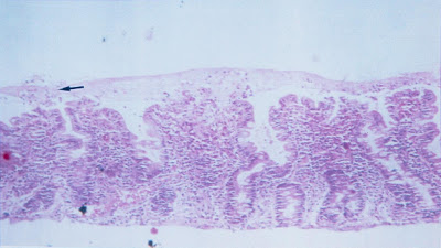 Figura 4- Material de biópsia do intestino delgado de um paciente portados de AIDS evidenciando uma camada muco-fibrino-leuccocitária recobrindo a superfície epitelial (seta) e também uma solução de continuidade (úlceração) do epitélio do intestino delgado no topo das vilosidades.