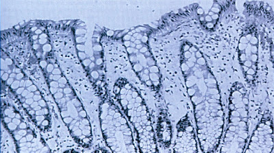 Figura 5- Material de biópsia do intestino grosso obtida já na fase de depleção imunológica evidenciando ausência praticamente total do infiltrado inflamatório linfo-plasmocitário na lâmina própria.