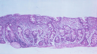 Figura 5- Material de biópsia de um paciente portador de AIDS evidenciando atrofia vilositária sub-total com hiplerplasia das glândulas crípticas e intenso infiltrado inflamatório linfo-plasmocitário na lâmina própria.