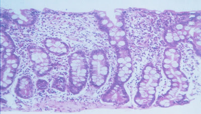 Figura 6- Material de biópsia do intestino delgado evidenciando atrofia vilositária sub-total e hiperplasia das glândulas crípticas.