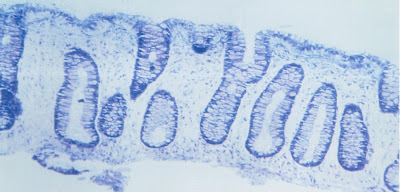 Figura 7- Material de biópsia do intestino grosso evidenciando importante depleção do infiltrado linfo-plasmocitário na lâmina própria.