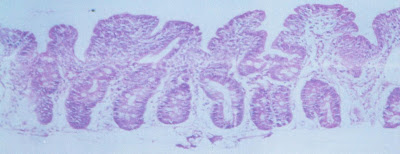 Figura 8- Material de biópsia do intestino delgado evidenciando atrofia vilositária de grau moderada/intensa com hiperplasia das criptas e aumento do infiltrado linfo-plasmocitário na lâmina própria.