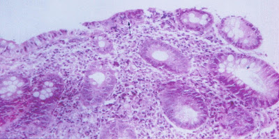 Figura 9- Material de biópsia de intestino grosso mostrando uma lesão de colite focal ativa (seta).