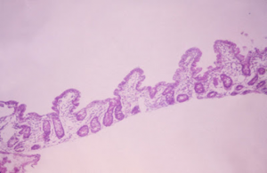 Figura 7- Fotografia em aumento médio de espécime de intestino delgado obtido por biópsia evidenciando atrofia vilositária moderada, chamando a atenção para a "População Vilositária Diminuida".