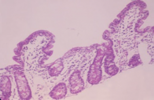 Figura 8- Fotografia em maior aumento de espécime de intestino delgado obtido por biópsia; notar o espaço nitidamente aumentado entre 2 vilosidades adjacentes.