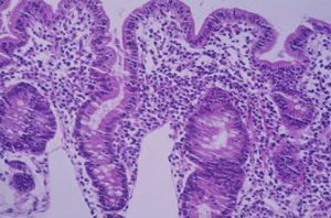 Figura 9- Fotografia em aumento maior de espécime de intestino delgado obtido por biópsia demonstrando atrofia vilositária subtotal e intenso infiltrado linfo-plasmocitário na lâmina própria.