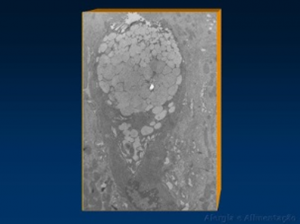 Figura 3- Ultramicrofotografia de uma célula caliciforme repleta de muco em seu interior.