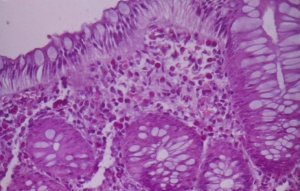 Figura 2- Microfotografia da mucosa colônica evidenciando infiltrado eosinofílico permeando o epitélio, na lâmina própria e nas glândulas crípticas.