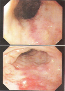 Figura 3- Mucosa colônica evidenciando intensa hiperemia.