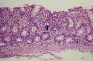 Figura 4- Microfotografia da mucosa colônica evidenciando erosão do epitélio, aumento do infiltrado linfo-plasmocitário na lâmina própria, diminuição do conteúdo de muco nas glândulas crípticas e presença de polimorfonucleares no interior da glândula críptica (abscesso críptico - seta).