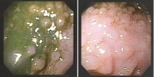 Figura 5- Mucosa colônica evidenciando a presença de nódulos linfóides hiperplasiados.