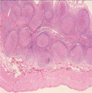 Figura 6- Microfotografia em microscopia óptica comum em grande aumento da mucosa colônica evidenciando a presença de inúmeros nódulos linfoides hiperplasiados na lâmina própria.