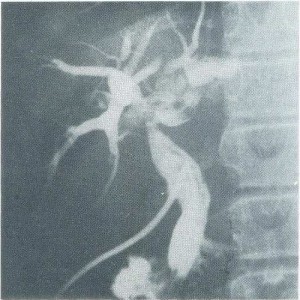 Figura 1 - Colangiografia retrógrada intra-operatória evidenciando dilatação dos ductos biliares intra-hepáticos.
