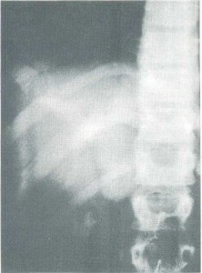 Figura 2 - Colanqiografia intravenosa mostrando dilatação cística dos ductos biliares intra-hepáticos